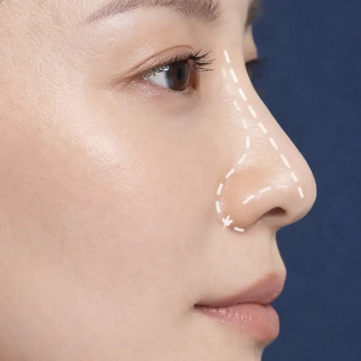 Rhinoplasty