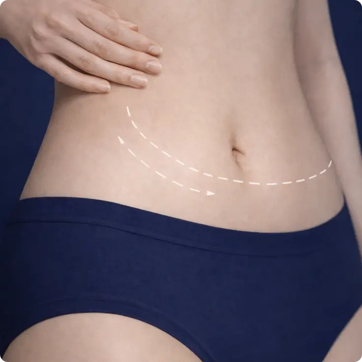 Tummy Tuck